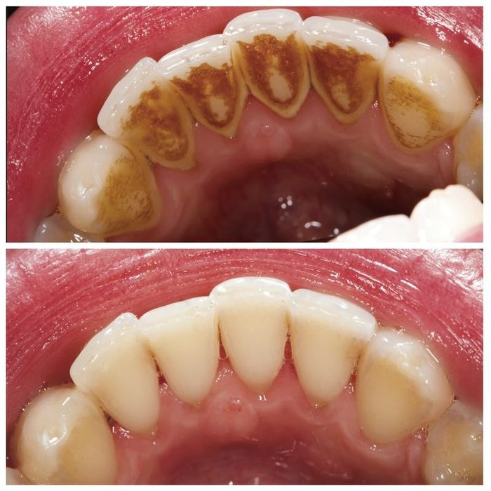 Before and after example of professional scaling and polishing removing tartar from the lower front teeth