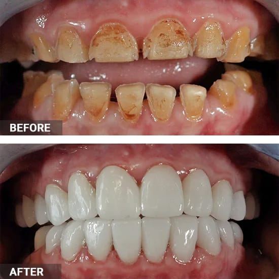 Before and after example of cosmetic bonding and veneers restoring worn, discoloured front teeth