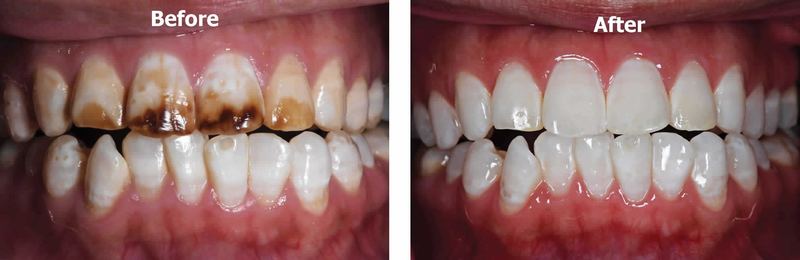 Before and after example of minimally invasive treatment for stained, fluorosis-affected teeth