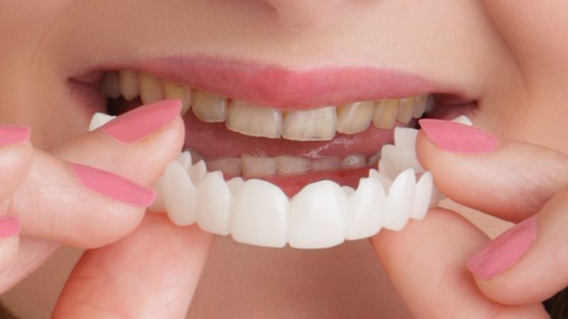 Close-up of a set of veneers being fitted over the upper teeth