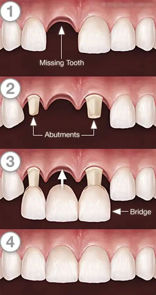 Step-by-step illustration of how a dental bridge replaces a missing tooth