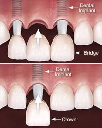 Illustration comparing an implant-supported bridge with a single implant crown