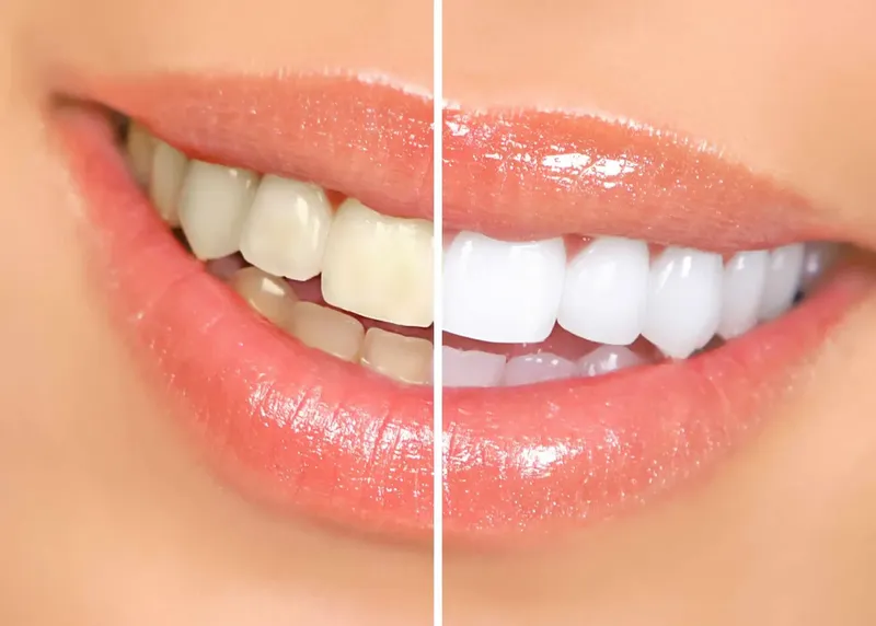 Before and after example of a teeth whitening result